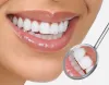 The Best Teeth Whitening Kits of 2020 : ext_5889408 — LiveJournal