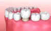    Pros and Cons of Same Day Crowns: ext_5889408 — LiveJournal