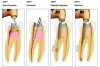 Five Reasons That You Need A Root Canal Treatment – Emergency Dentist in Houston