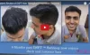 Best hair Transplant in India - Satya Hair Transplant Clinic