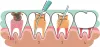 Tooth extraction: When Is It Necessary? &raquo; Emergencydentalclinic