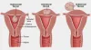 Fibroid Surgery Cost in delhi