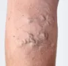 Vein Treatment Houston: Sclerotherapy: An Uncomplicated Treatment For Spider Veins
