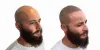 6 Reasons to Consider Scalp Micropigmentation 