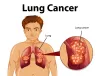 risk factors of Lung Cancer