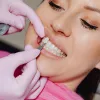 5 Reasons You Are a Good Candidate for Veneers | El Paso