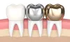   	The Different Types of Dental Crowns You Should Know About | Clove Dental | Dentagama  