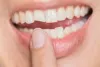 Chipped Teeth repair in London Ontario
