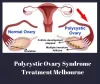 Polycystic Ovary Syndrome Treatment Options in Melbourne: drgseo2018