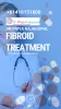 Fibroid treatment - JustPaste.it