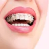 Braces Englewood | Adult Braces Englewood