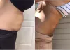 Know The Therapeutic Options For Liposuction