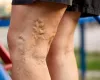  &raquo; Is Varicose Veins a Hazardous Condition? - veinclinicsnorthwest