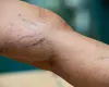 What Causes Spider Veins in Women? 