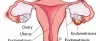 6 Things to Know About Endometriosis