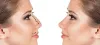 Rhinoplasty Treatment in Jaipur