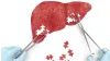 Top 10 Lifestyle Changes to Prevent Fatty Liver: A Comprehensive Guide | Longevity