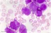 Get The Best Treatment For Bone Marrow Cancer