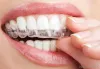 Are Invisalign Braces Worth It?