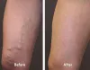 Sclerotherapy