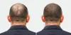 Important Things To Know Before Going to Hair Transplant Clinic
