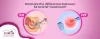 Differences Between IUI and IVF treatment | Guest Blog