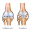 Alternative Treatments For Chronic Osteomyelitis Disease - Herbs Solutions By Nature Blog