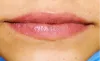 Lip Depigmentation with Laser