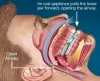 Snoring treatment in Mumbai