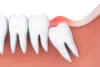 When Wisdom Tooth Extraction Becomes Necessary?