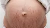 Pregnancy Stretch Marks: Causes &amp; Solutions &ndash; PregaJunction