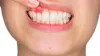 Dental Abscess What should you know - EmergencyDentistHouston