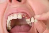Why You Should See A Prosthodontist?