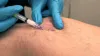 Vein Clinic NY — How to Find the Best Vein Doctor?