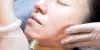 Facial Rejuvenation using 'vampire' procedures