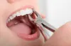 When is a tooth extraction necessary?