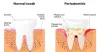 7 Benefits of Using Laser Therapy for Periodontal Disease