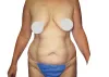 Are You Ready For A Mommy Makeover?