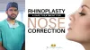 Rhinoplasty/Septoplasty Surgeon in Hyderabad | Nose Surgery Cost in Gachibowli