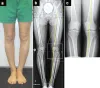 Knee unloader braces