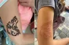Australian Mother's Warning on Black Henna Tattoos After Daughter Suffers Severe Reaction in Bali