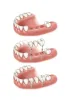 Multiple Teeth Replacement chicago
