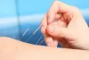 Acupuncture Therapist In Gaithersburg