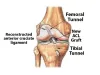Anterior Cruciate Ligament Reconstruction - Find Out Its Procedure