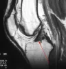 Treat ACL tear without surgery