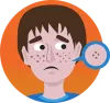 Causes of Acne and Tips to remove Acne