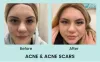 Melasma treatment in Vancouver bc