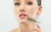 Causes of Acne Scars and Know How to Get Rid of Them