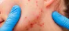 Acne in Children - Federal Way Pediatric Associates