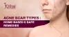 Acne Scars Types and Their Easy &amp; Safe Remedies - Skin Solutionz